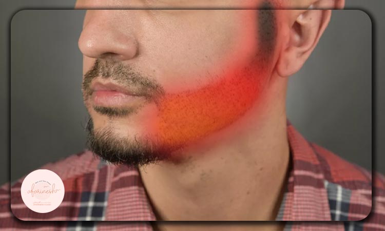 جای زخم کاشت ریش