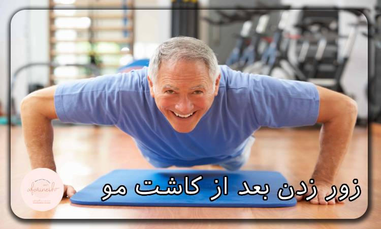 زور زدن بعد از کاشت مو