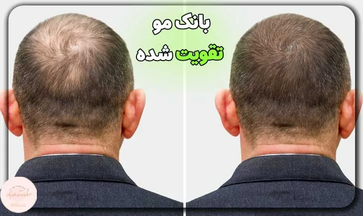 عکس بانک مو تقویت شده