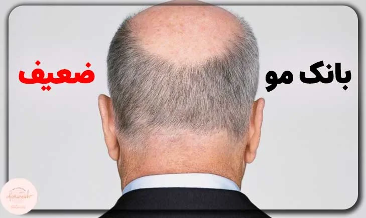عکس بانک مو ضعیف