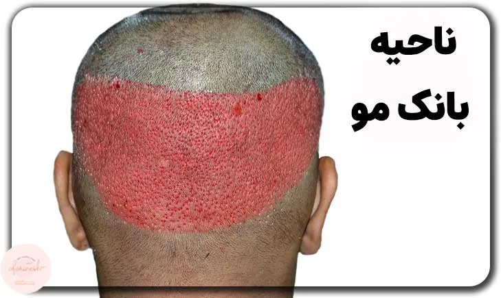 عکس ناحیه بانک مو