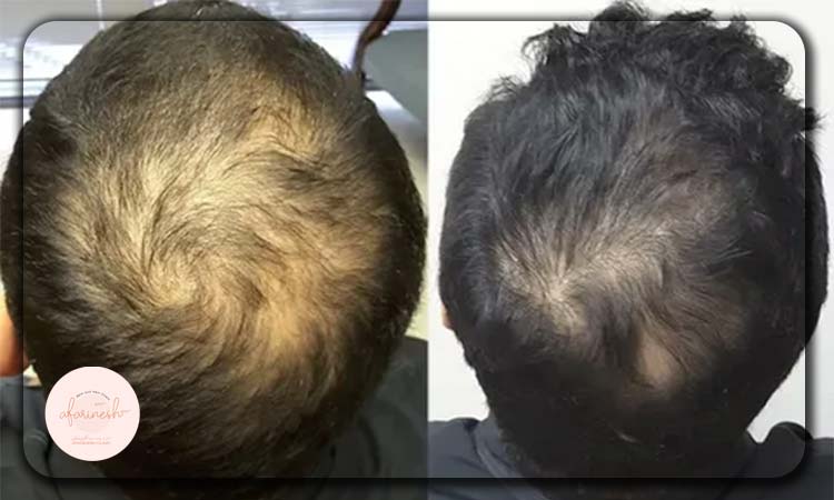 عکس قبل و بعد مزوتراپی مو