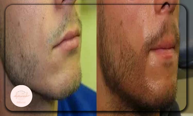 عکس قبل و بعد کاشت ریش