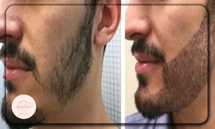 نمونه قبل و بعد کاشت ریش