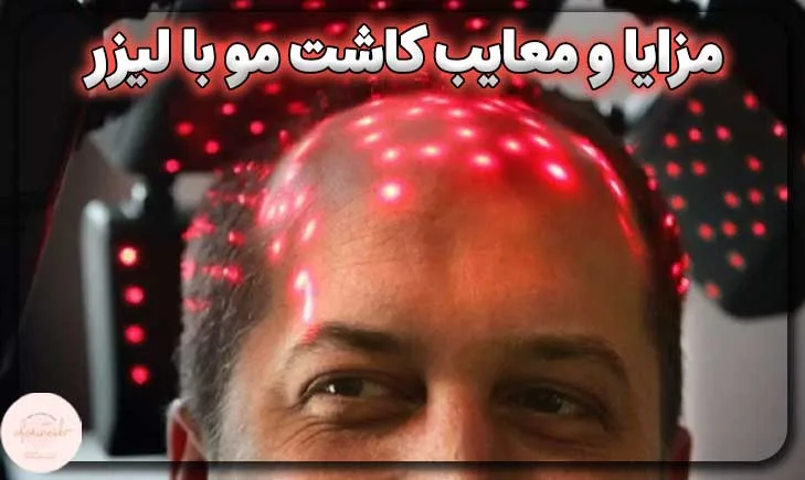 مزایا و معایب کاشت مو با لیزر