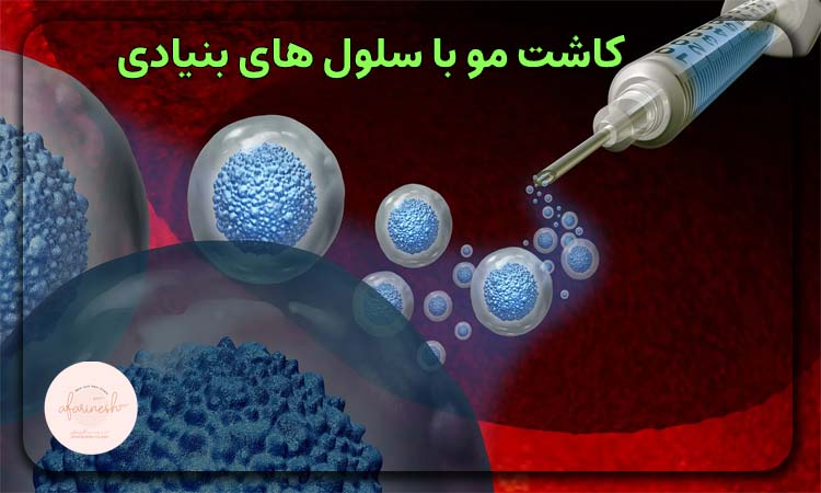 کاشت مو با سلول های بنیادی
