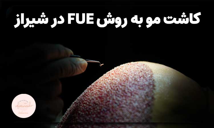 کاشت مو به روش FUE در شیراز