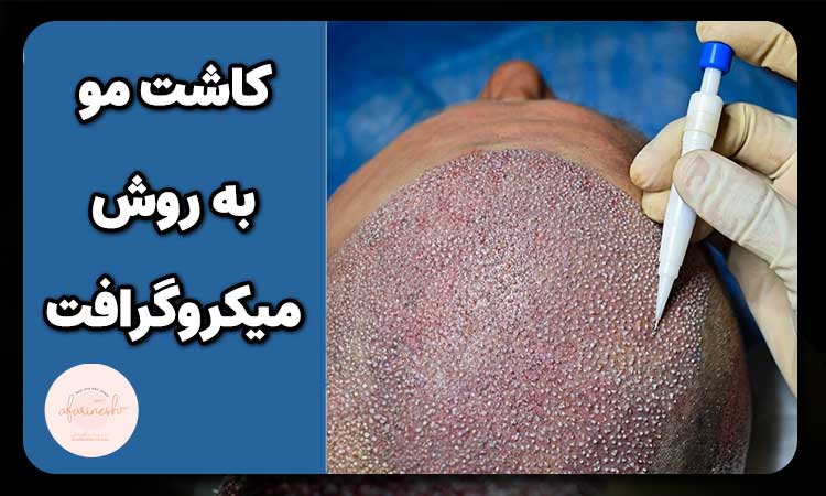 کاشت مو به روش میکروگرافت