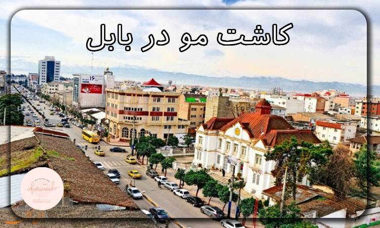 کاشت مو در بابل