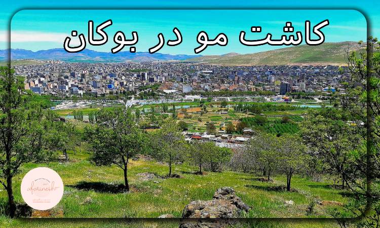 کاشت مو در بوکان