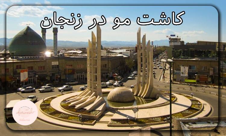 کاشت مو در زنجان