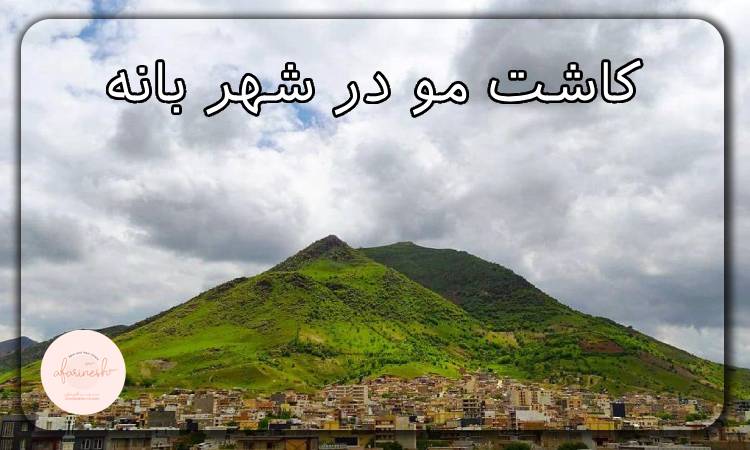 کاشت مو در شهر بانه