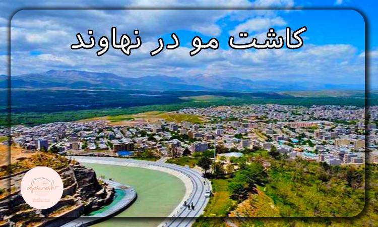 کاشت مو در نهاوند