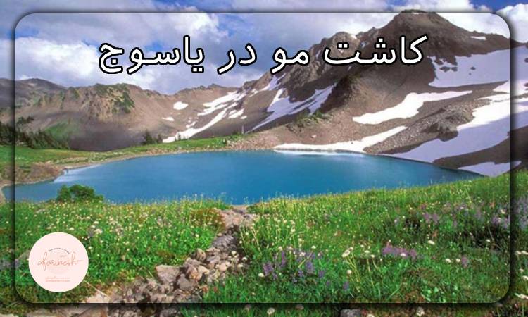کاشت مو در یاسوج
