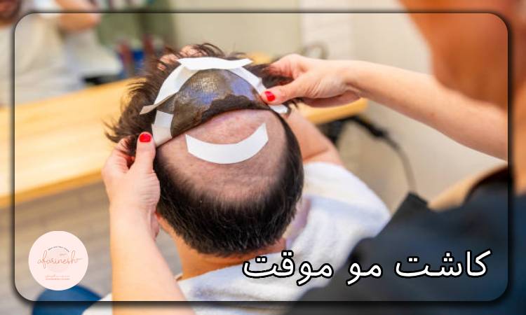 کاشت مو موقت
