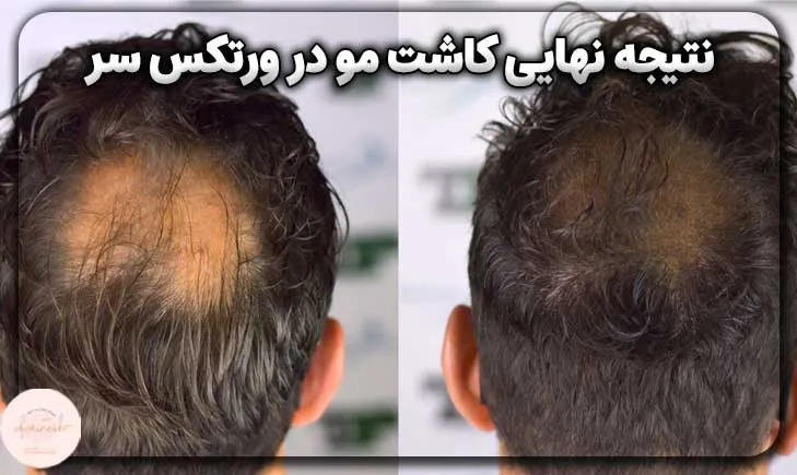 نتیجه نهایی کاشت مو در ورتکس سر