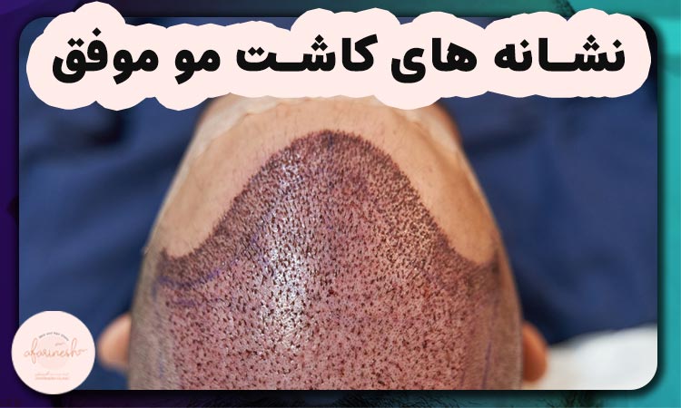نشانه های کاشت مو موفق