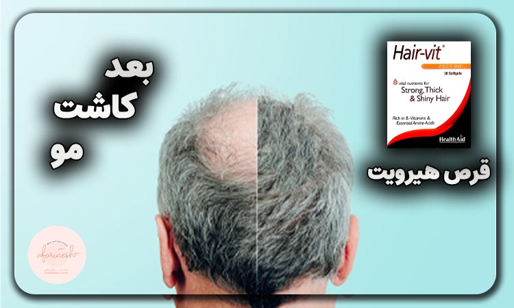 قرص هیرویت بعد از کاشت مو