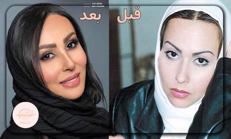 تصویر قبل و بعد کاشت ابرو پرستو صالحی