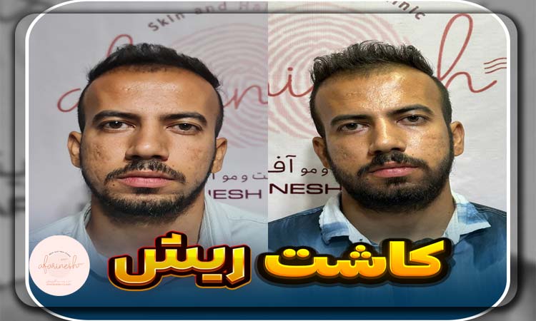 قبل و بعد کاشت ریش