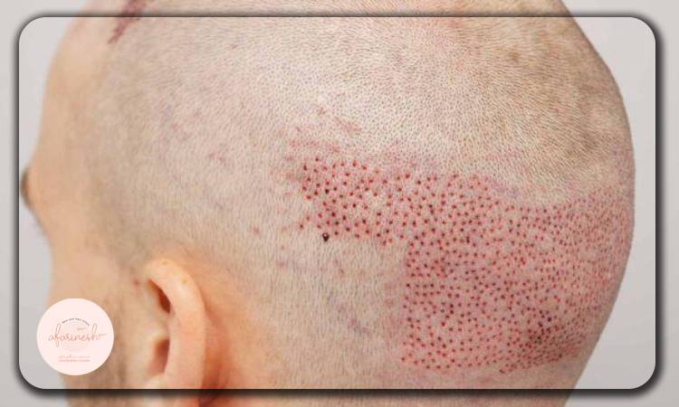 سوزش پشت سر بعد از کاشت مو چه زمانی رفع میشود؟