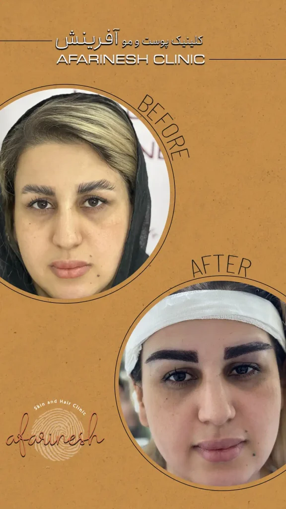 نمونه کار کاشت ابرو