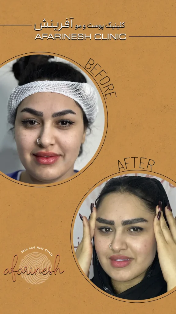 عکس کاشت ابرو بعد از یک ماه