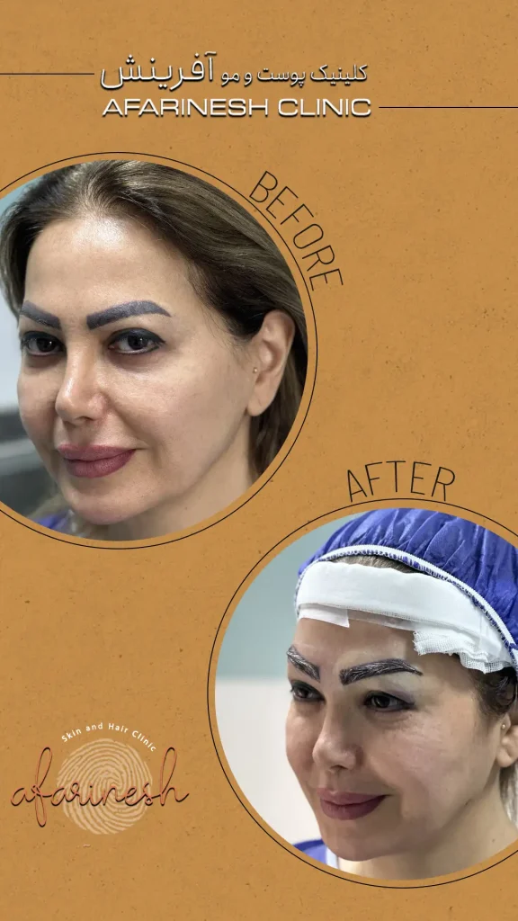 عکس کاشت ابرو طبیعی بعد از یک ماه