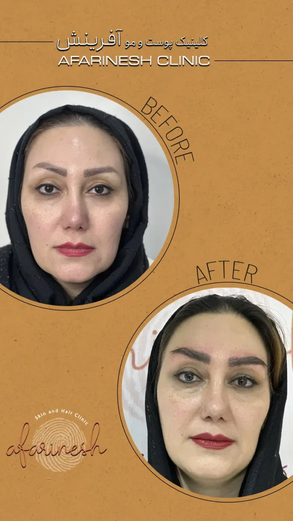 عکس کاشت ابرو بعد از یک ماه