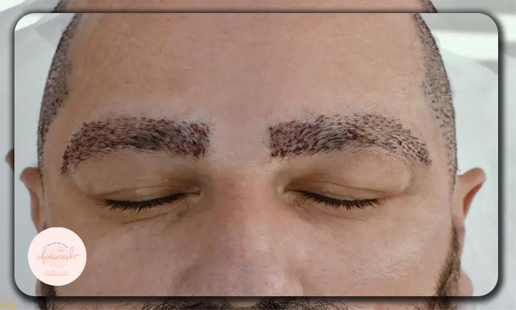 هزینه کاشت ابرو در بیمارستان عرفان نیایش