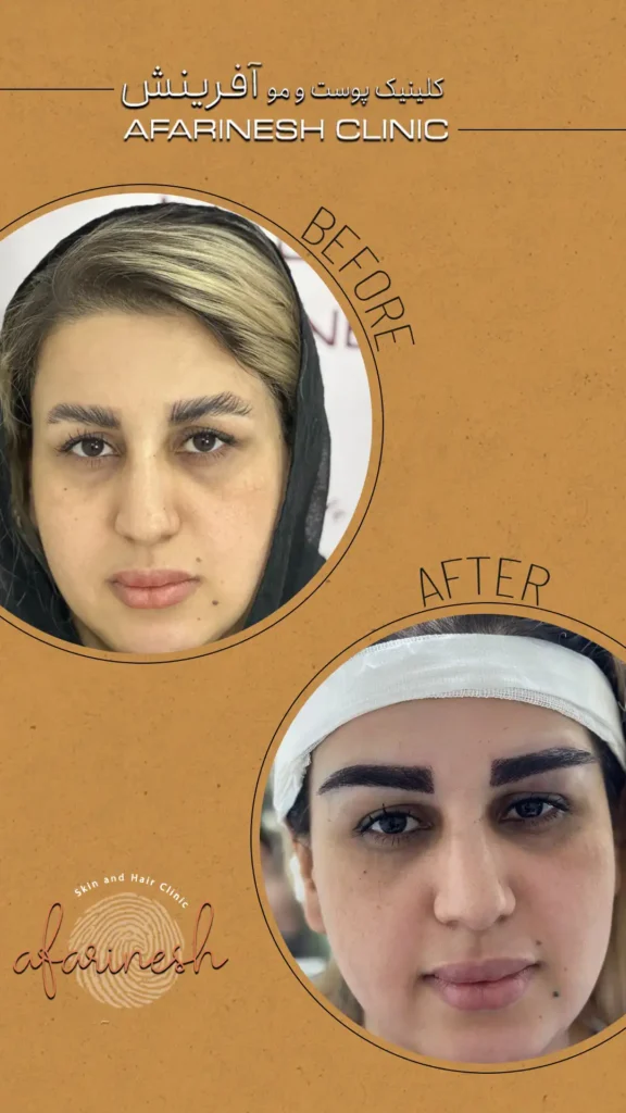 نمونه کار کاشت ابرو