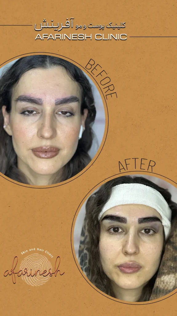 عکس کاشت ابرو بعد از یک ماه