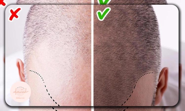 عوارض کاشت ریش و سبیل ارزان