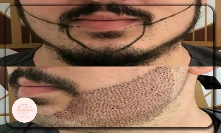 قبل کاشت ریش