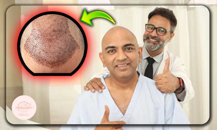 آیا کاشت مو باعث سرطان میشود