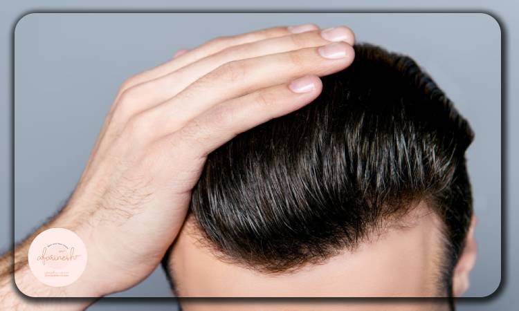 مقایسه کاشت مو موقت با کاشت مو دائمی
