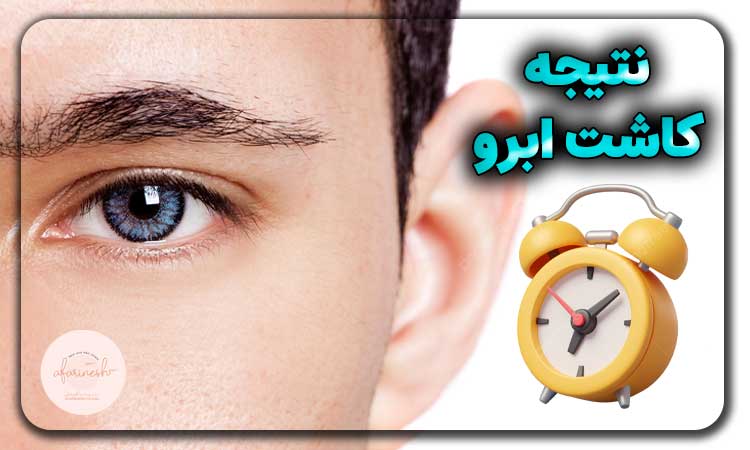 کاشت ابرو بعد از چند ماه نتیجه می دهد