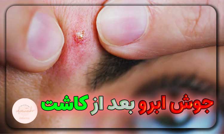 جوش ابرو بعد از کاشت ابرو