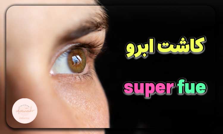 کاشت ابرو به روش super fue