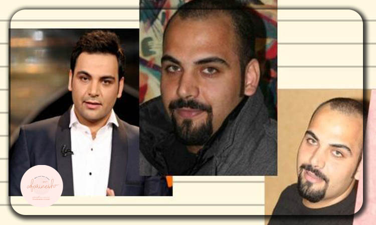 عکس احسان علیخانی قبل و بعد از کاشت مو