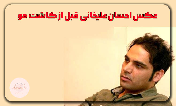 عکس احسان علیخانی قبل از کاشت مو