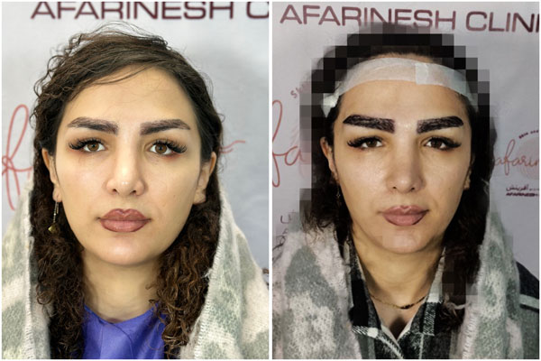 قبل و بعد کاشت ابرو طبیعی