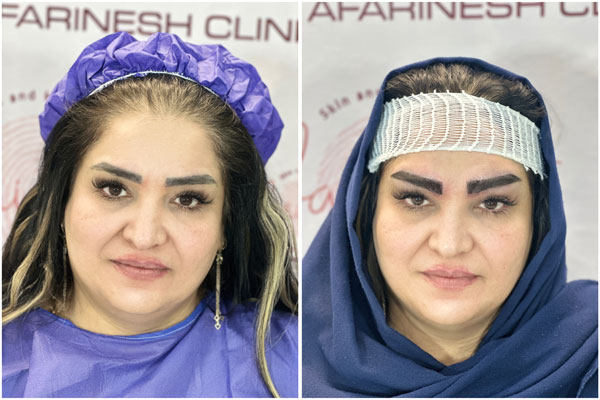 قبل بعد کاشت ابرو