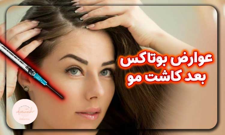 عوارض بوتاکس بعد از کاشت مو