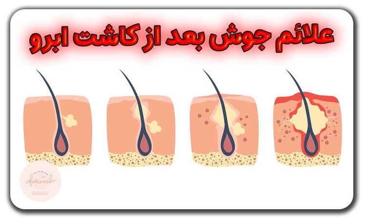 علائم جوش بعد از کاشت ابرو