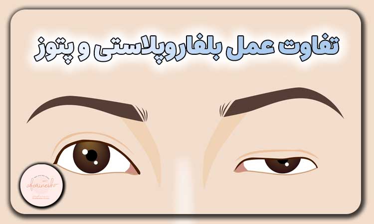تفاوت عمل بلفاروپلاستی و پتوز