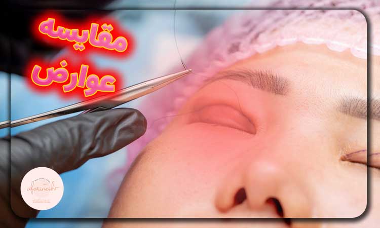 مقایسه عوارض بلفاروپلاستی و پتوز