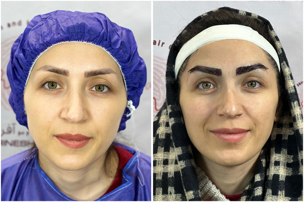 عکس کاشت ابرو بعد یکسال