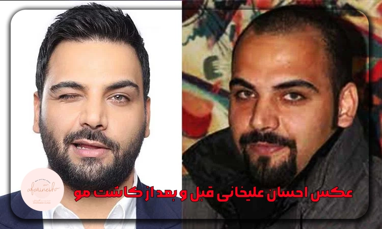 احسان علیخانی قبل و بعد از کاشت مو