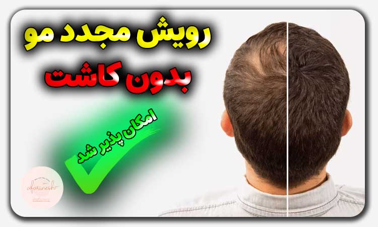 رویش مجدد مو بدون کاشت